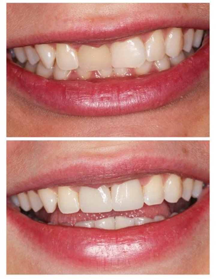 A Journey From Before To After Veneers